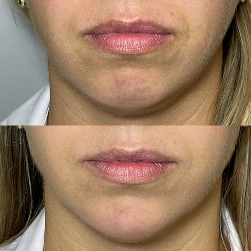 What is the difference between jawline fillers and chin fillers?